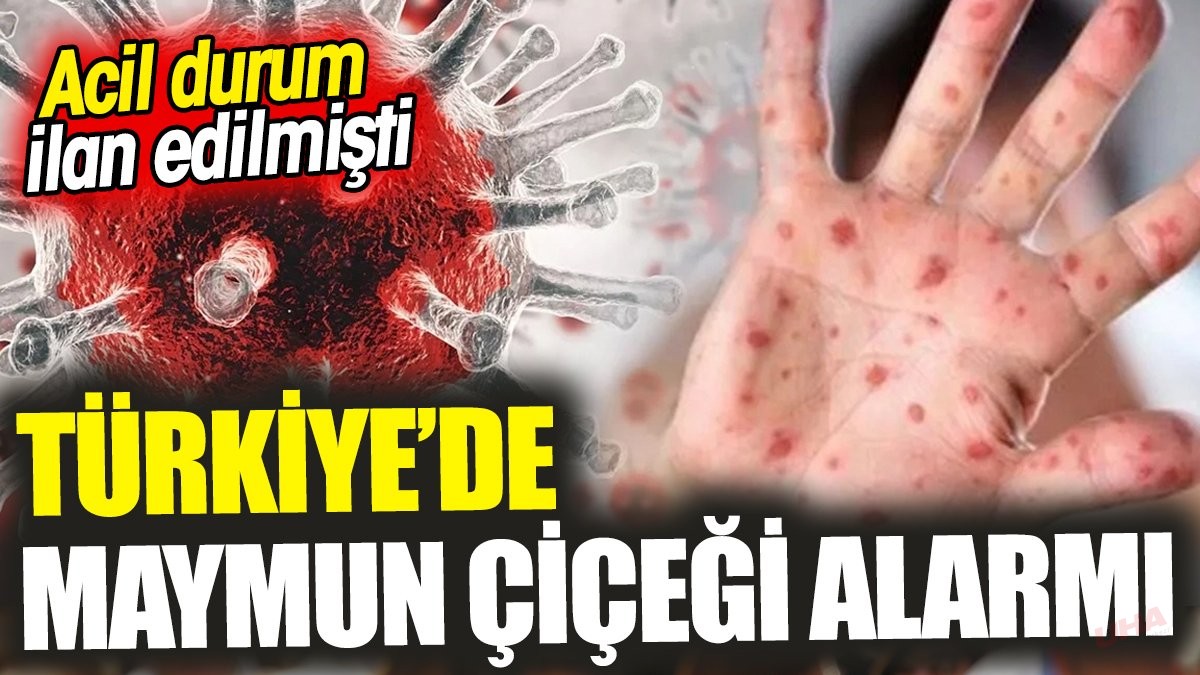 Türkiye’de maymun çiçeği alarmı ‘Acil durum ilan edilmişti