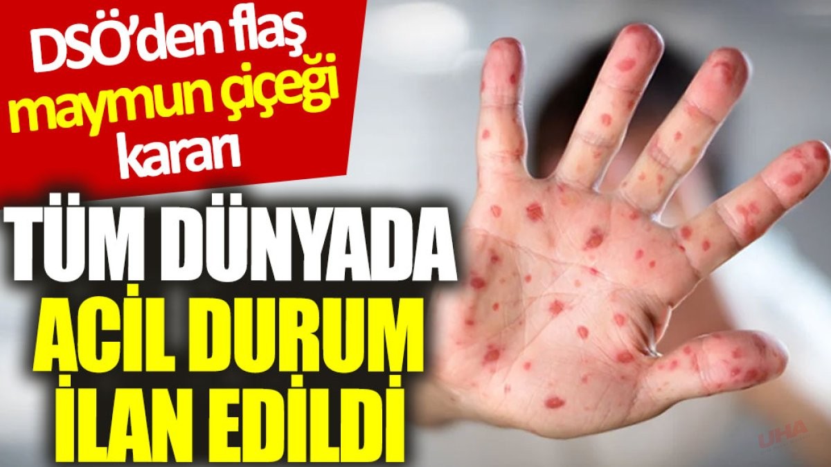 DSÖ’den ‘maymun çiçeği’ kararı: Tüm dünyada acil durum ilan edildi